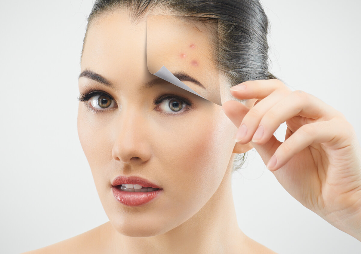 Acne Treatment from a Dermatologist in Plano TX Area