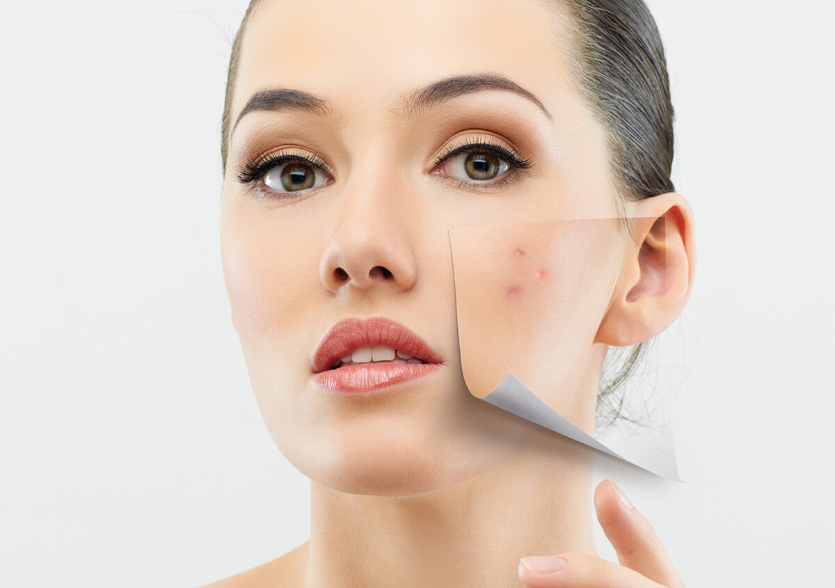 Acne Skin Care in Plano TX Area