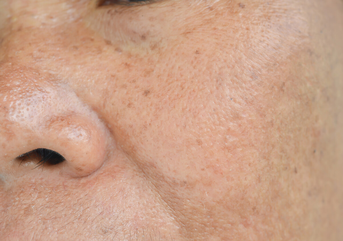 Best Treatment for Brown Spots on Face in Plano Area