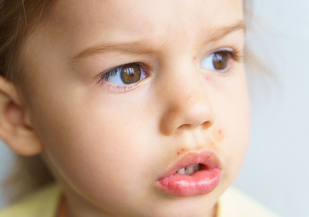 Face Rashes in Children in Plano Area
