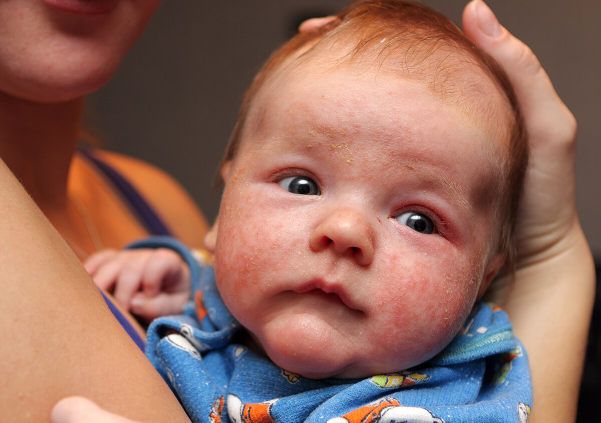 Infantile Eczema in Plano Area