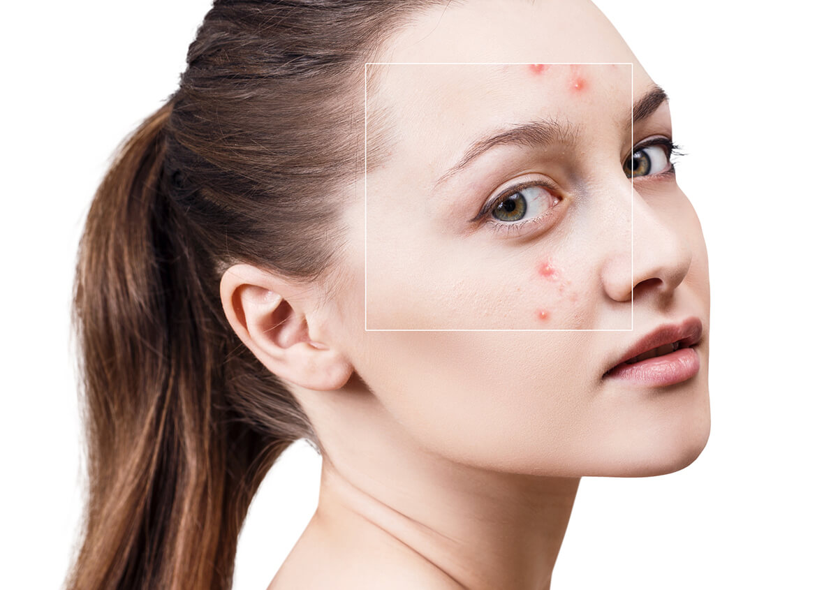 Microdermabrasion for Acne in Plano Area