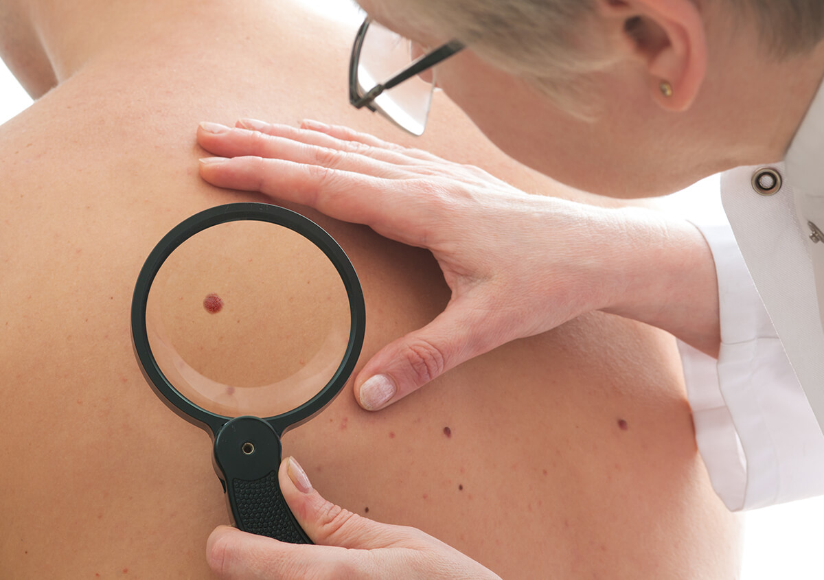 Skin Cancer Treatment in Plano TX Area