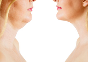 For minimally invasive Kybella double chin removal procedure, set a consultation meeting with Dr. Achtman or Dr. McConnell of DSA Dermatology in Plano, TX