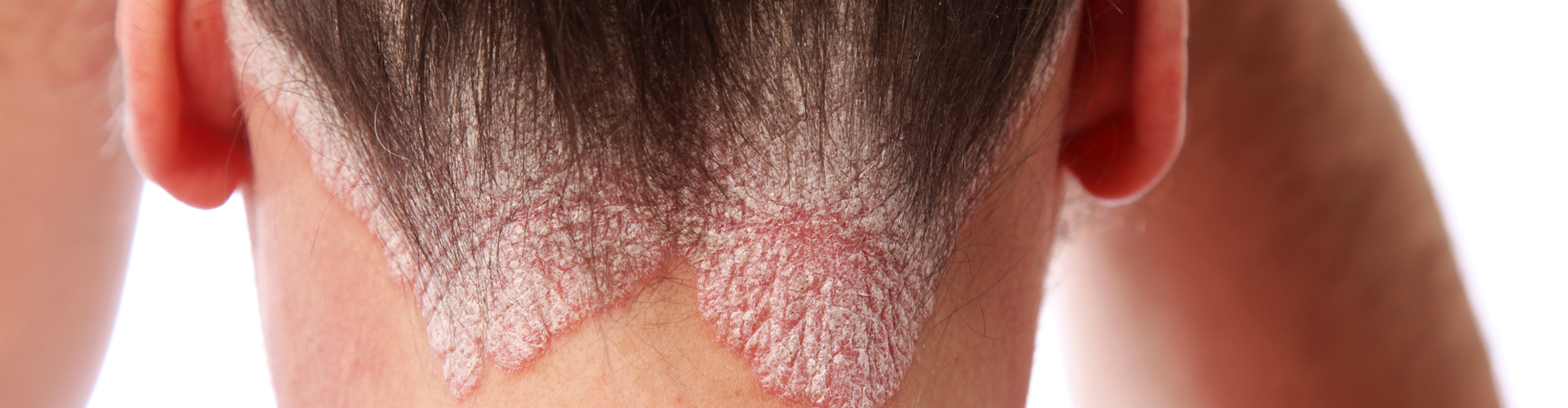 Psoriasis and Eczema Treatment Options in Plano TX